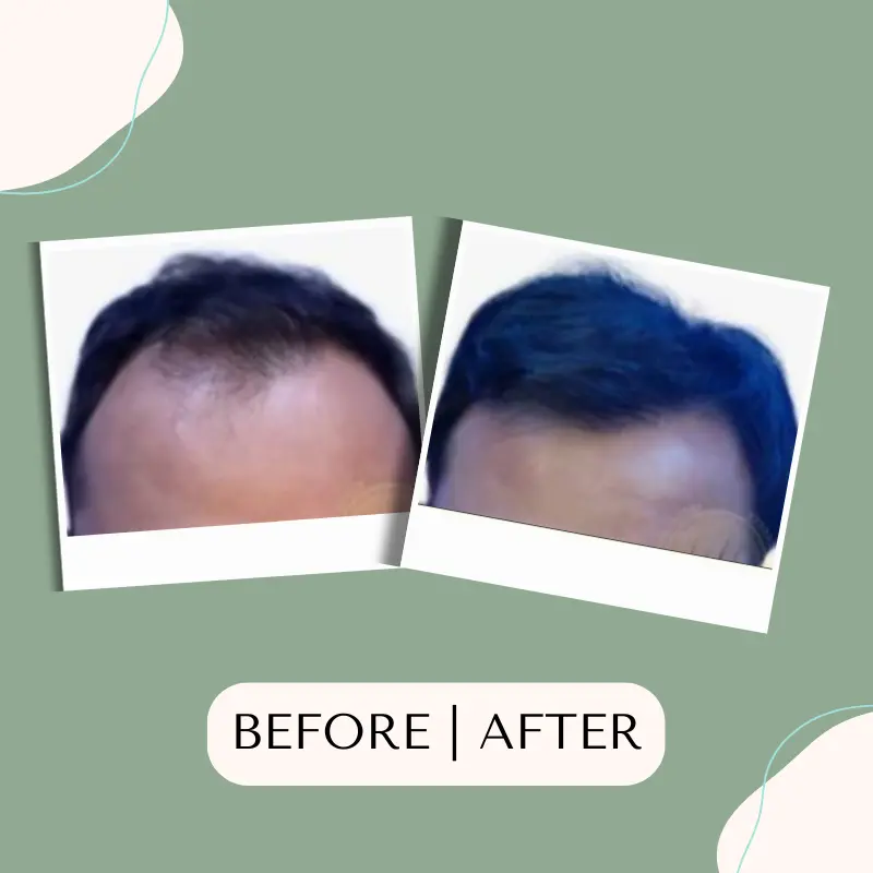 tanam-rambut-fue,tanam-rambut,tanam-rambut-indonesia,tanam-rambut-klinik