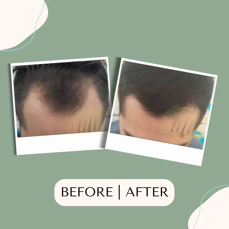 tanam-rambut-fue,tanam-rambut,tanam-rambut-indonesia,tanam-rambut-klinik