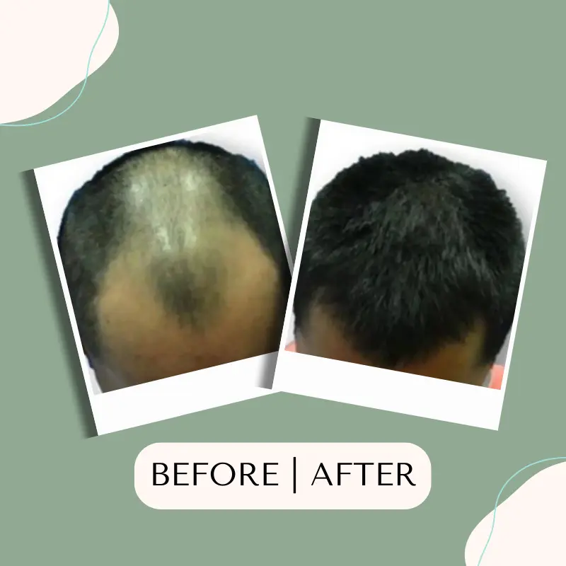 tanam-rambut-fue,tanam-rambut,tanam-rambut-indonesia,tanam-rambut-klinik