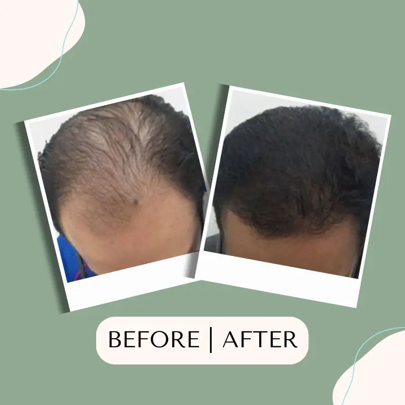 tanam-rambut-fue,tanam-rambut,tanam-rambut-indonesia,tanam-rambut-klinik