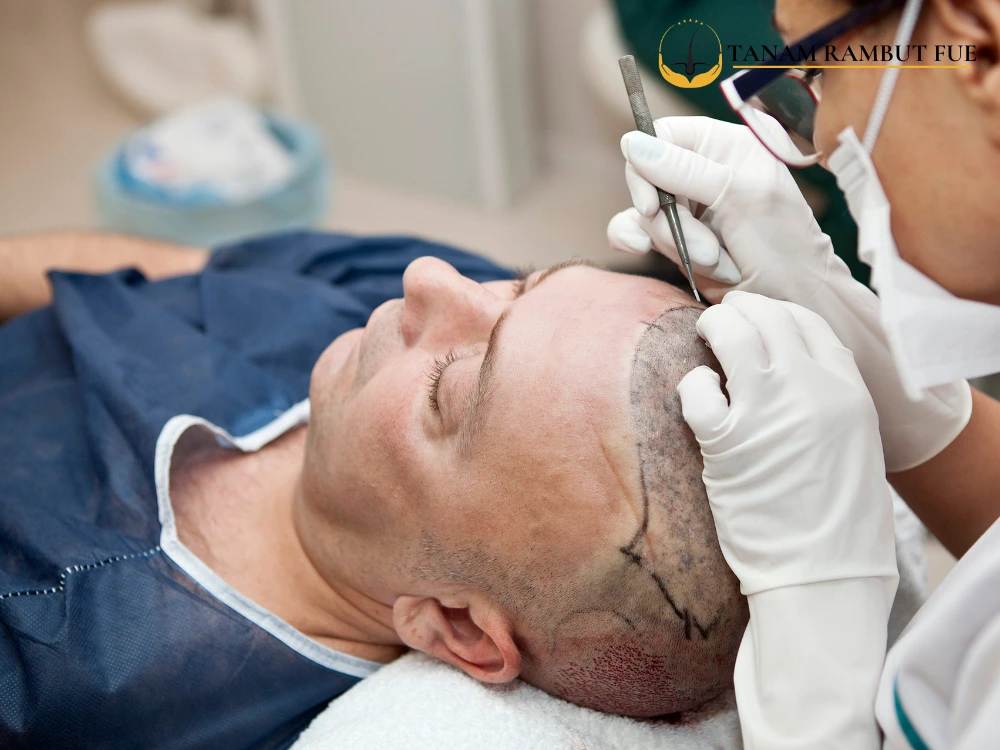 biaya-implan-rambut,biaya-implan-rambut-indonesia,biaya-implan-rambut-klinik