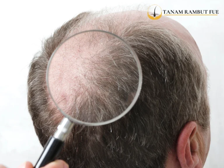 Cara Transplantasi Rambut: Panduan Lengkap dan Langkah-langkahnya