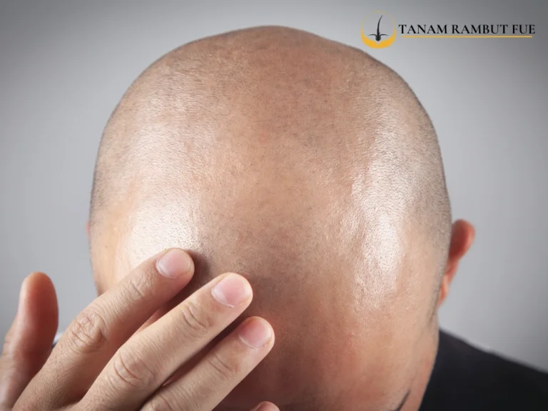 Operasi Transplantasi Rambut: Solusi Terbaik untuk Kebotakan