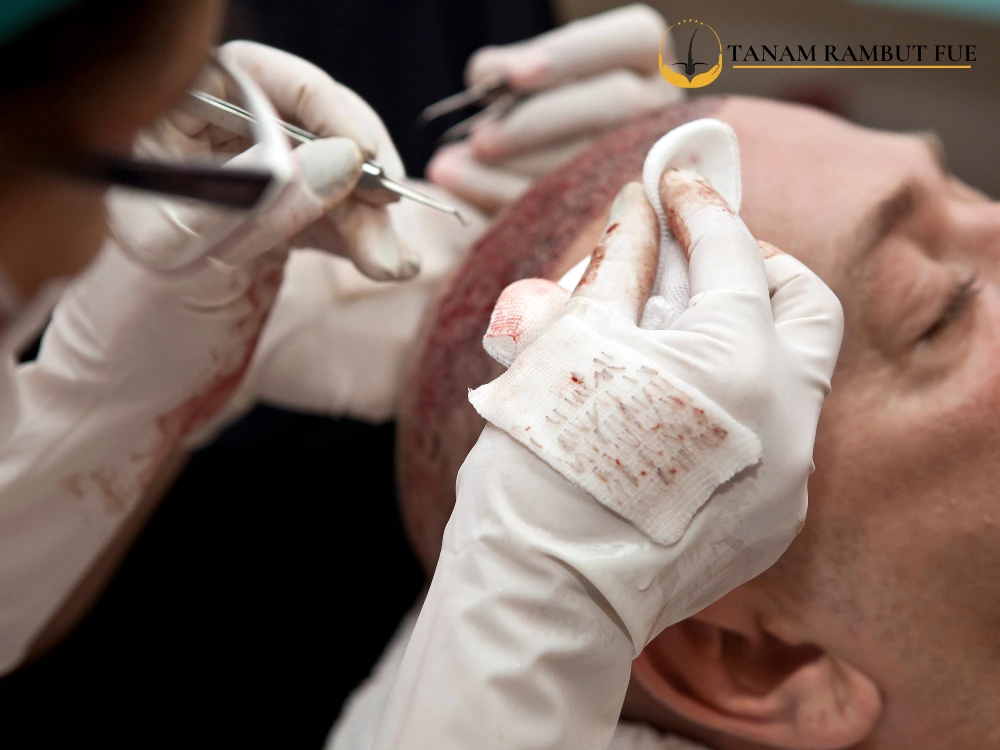 proses-tanam-rambut,proses-tanam-rambut-jakarta,proses-tanam-rambut-klinik,proses-tanam-rambut-indonesia