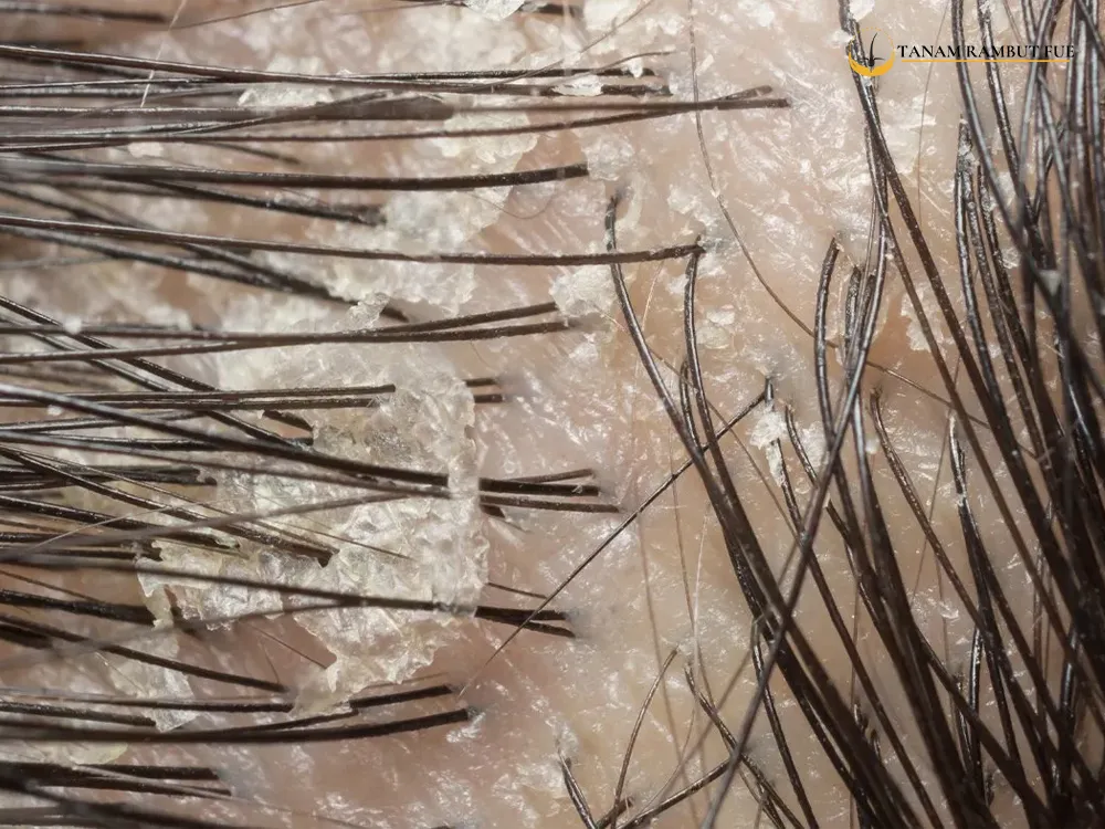 ketombe-rambut-biaya-tanam-rambut-turki-malaysia-indonesia-1