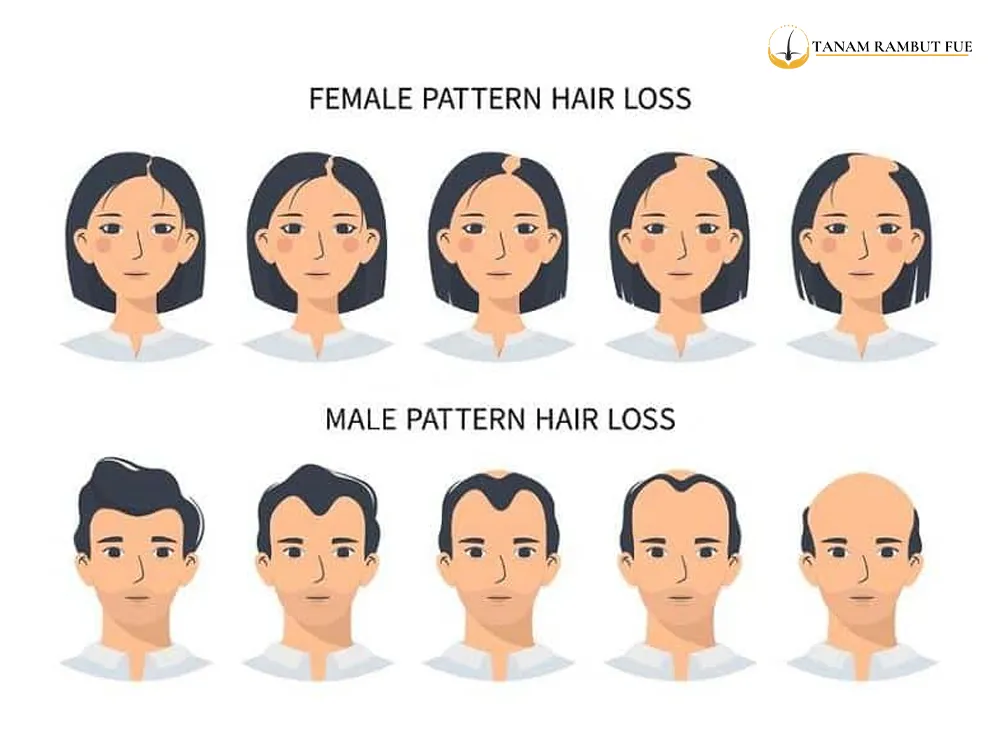 rambut-rontok-biaya-tanam-rambut-turki-malaysia-indonesia-1