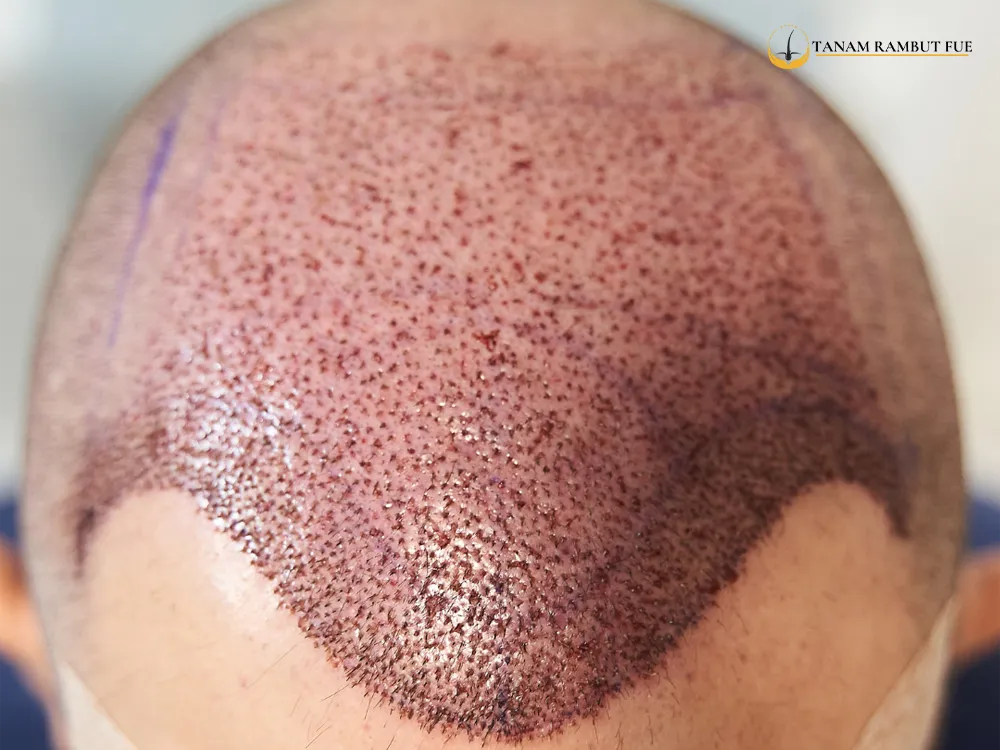 transplantasi-biaya-tanam-rambut-turki-malaysia-indonesia-4