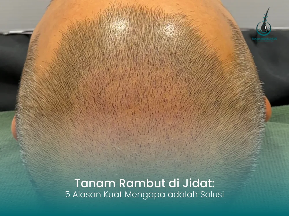 tanam-rambut-di-jidat