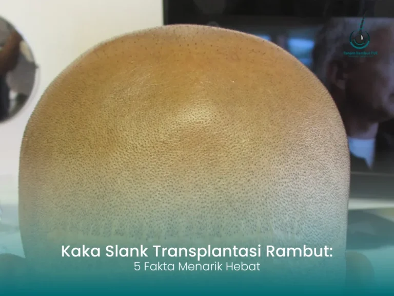 kaka-slank-transplantasi-rambut