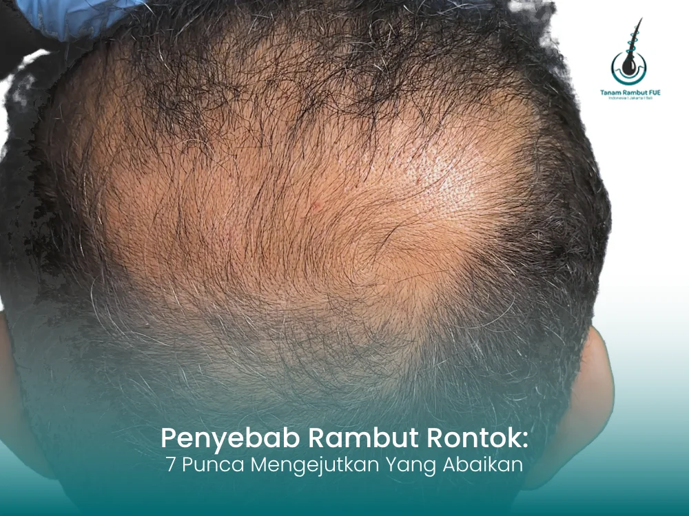 penyebab-rambut-rontok