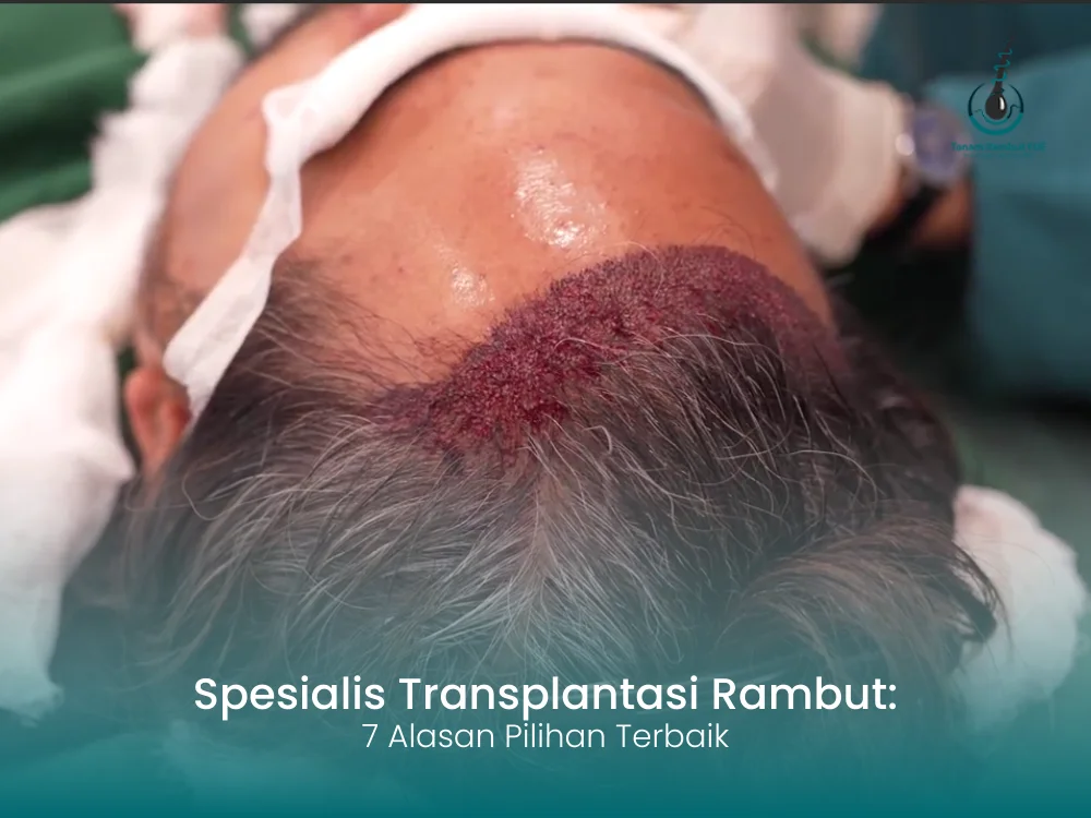 spesialis-transplantasi-rambut