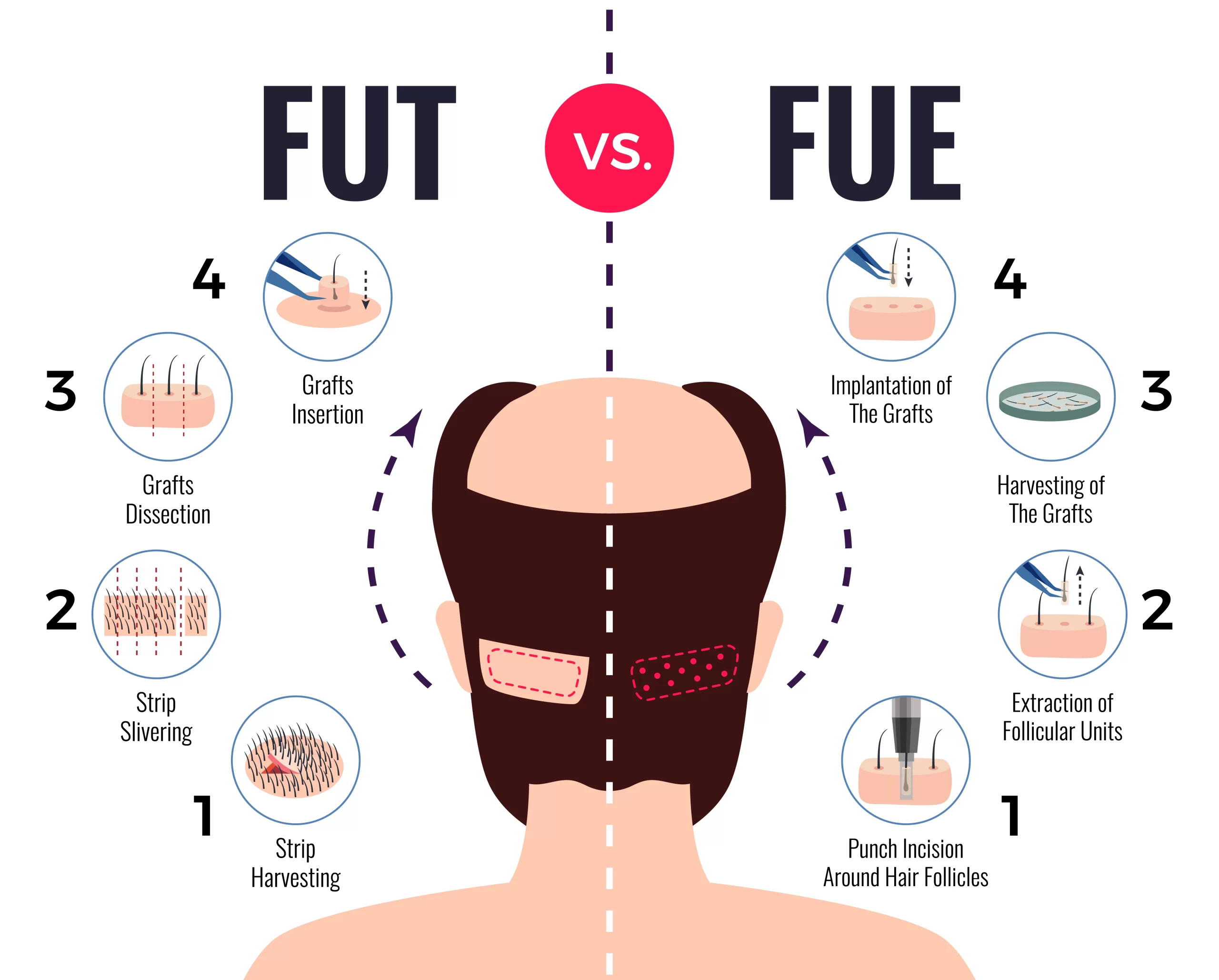 transplantasi-rambut-fue-fut