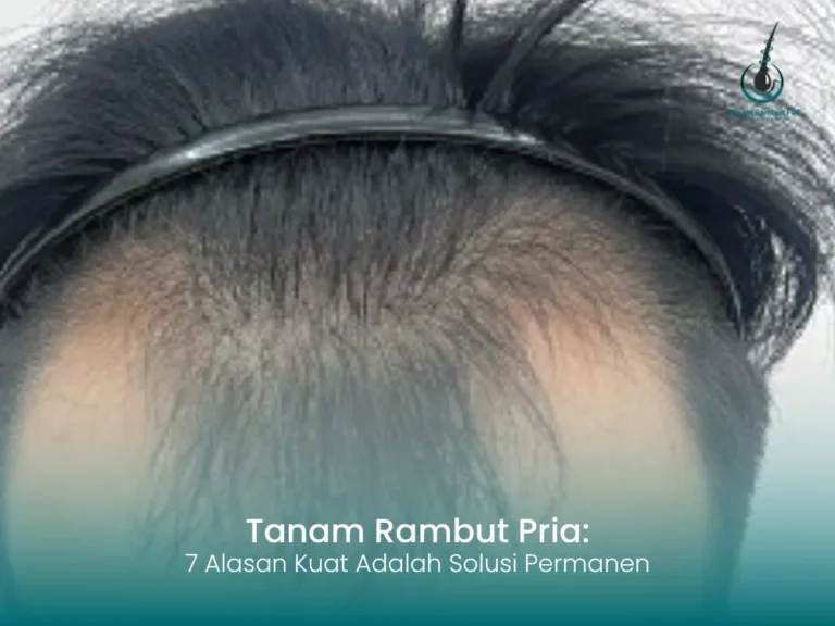 tanam-rambut-pria