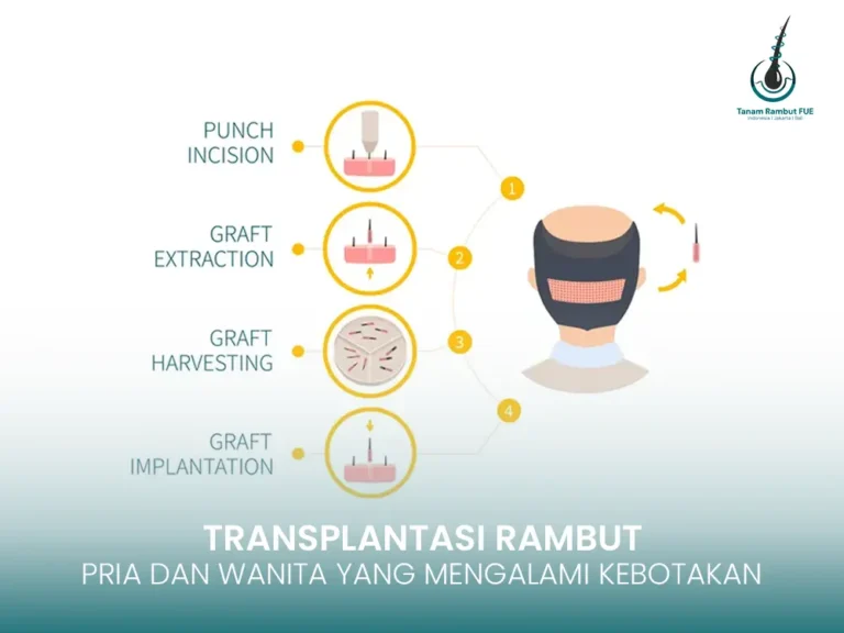 Transplantasi Rambut: Solusi Permanen untuk Pria dan Wanita yang Mengalami Kebotakan