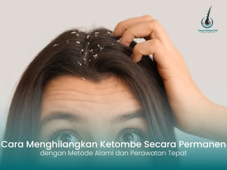 Cara Menghilangkan Ketombe Secara Permanen dengan Metode Alami dan Perawatan Tepat