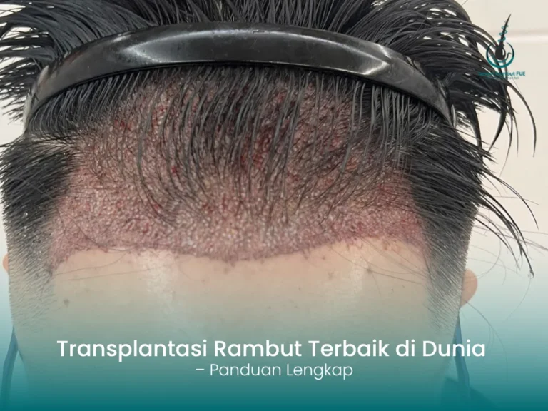 Transplantasi Rambut Terbaik di Dunia – Panduan Lengkap!