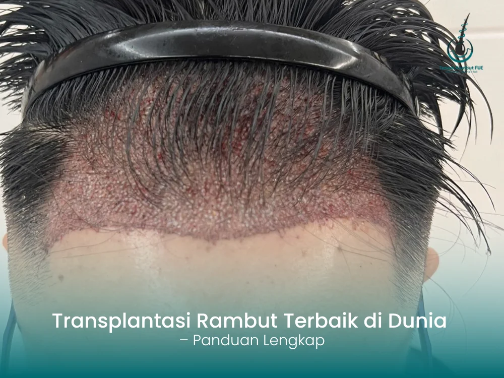transplantasi-rambut-terbaik-di-dunia